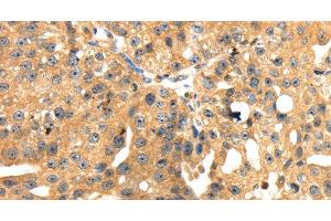 Immunohistochemistry of paraffin-embedded Human breast cancer tissue using SH3KBP1 Polyclonal Antibody at dilution 1:45 (SH3KBP1 抗体)