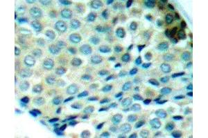 Immunohistochemistry of paraffin-embedded Human breast carcinoma using Phospho-HSPB1(S78) Polyclonal Antibody (HSP27 抗体  (pSer78))