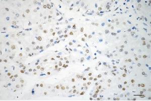 Immunohistochemistry was performed on paraffin-embedded human hepatocarcinoma using a-kinase anchoring protein 8 antibody (ABIN7797434), 1:200). (Recombinant AKAP8 抗体)