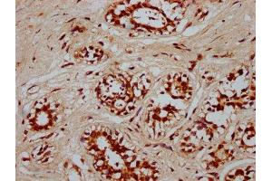IHC image of ABIN7166751 diluted at 1:300 and staining in paraffin-embedded human breast cancer performed on a Leica BondTM system. (POU5F1B 抗体  (AA 10-138))