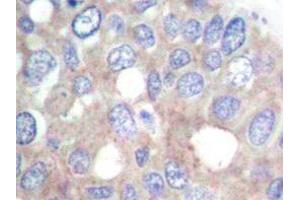 Immunohistochemistry analyzes of p70 S6K antibody in paraffin-embedded human breast carcinoma tissue. (RPS6KB1 抗体)