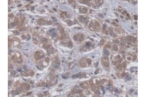 DAB staining on IHC-P; Samples: Human Breast cancer Tissue (GBP4 抗体  (AA 1-292))