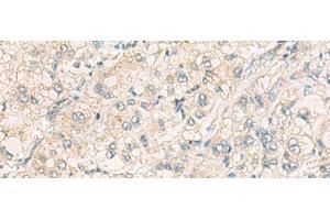 Immunohistochemistry of paraffin-embedded Human liver cancer tissue using THG1L Polyclonal Antibody at dilution of 1:70(x200) (THG1L 抗体)