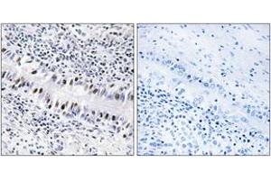 Immunohistochemistry analysis of paraffin-embedded human lung carcinoma, using ZNF76 Antibody. (ZNF76 抗体  (AA 116-165))