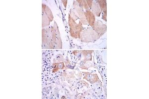 Immunohistochemical analysis of paraffin-embedded human muscle (upper) and human lung cancer (bottom) tissues using IL1B monoclonal antibody, clone 3A6  with DAB staining.