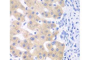 Immunohistochemistry of paraffin-embedded Human liver cancer using CYP2C18 Polyclonal Antibody at dilution of 1:100 (40x lens). (CYP2C18 抗体)
