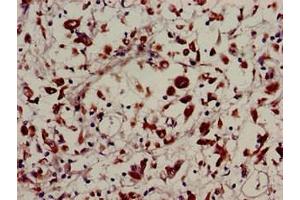 Immunohistochemistry of paraffin-embedded human melanoma using ABIN7174288 at dilution of 1:100 (USP22 抗体  (C-Term))