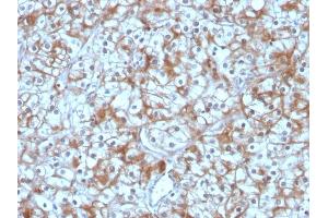 Formalin-fixed, paraffin-embedded human Bladder Carcinoma stained with Calpastatin Mouse Monoclonal Antibody (CAST/1550). (Calpastatin 抗体)