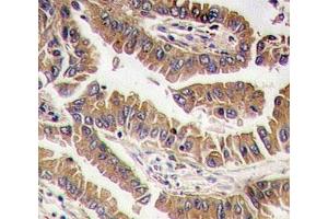 IHC analysis of FFPE human lung carcinoma tissue stained with BMP4 antibody