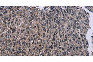 Immunohistochemistry of paraffin-embedded Human lung cancer using KDM4D Polyclonal Antibody at dilution of 1:50 (JMJD2D 抗体)