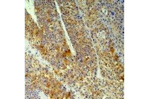 Immunohistochemical analysis of Cyclophilin B staining in human heptacancer,human pancreatic cancer formalin fixed paraffin embedded tissue section. (PPIB 抗体)