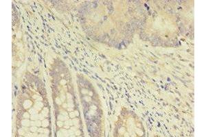 Immunohistochemistry of paraffin-embedded human colon cancer using ABIN7172114 at dilution of 1:100 (TK1 抗体  (AA 2-234))