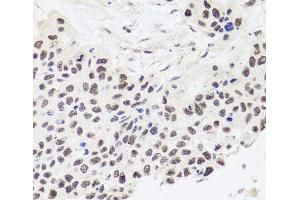 Immunohistochemistry of paraffin-embedded Human lung cancer using RPP30 Polyclonal Antibody at dilution of 1:100 (40x lens). (RPP30 抗体)