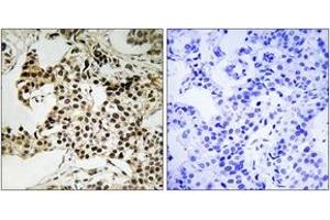 Immunohistochemistry analysis of paraffin-embedded human breast carcinoma, using PKR (Phospho-Thr258) Antibody. (EIF2AK2 抗体  (pThr258))