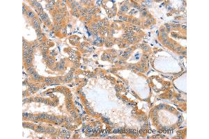 Immunohistochemistry of Human thyroid cancer using ACOT11 Polyclonal Antibody at dilution of 1:25 (ACOT11 抗体)