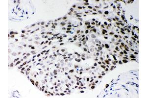 Anti- SF2 Picoband antibody, IHC(P) IHC(P): Human Mammary Cancer Tissue (SRSF1 抗体  (N-Term))