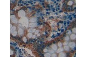IHC-P analysis of Human Tissue, with DAB staining. (LASP1 抗体  (AA 1-261))