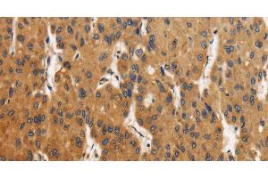 Immunohistochemistry of paraffin-embedded Human liver cancer using CALU Polyclonal Antibody at dilution of 1:40 (CALU 抗体)