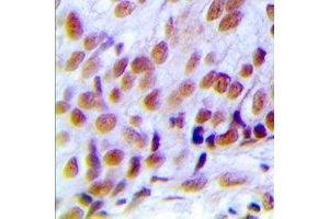 Immunohistochemical analysis of hNRNP C (pS260) staining in human breast cancer formalin fixed paraffin embedded tissue section. (HNRNPC 抗体  (C-Term, pSer260))