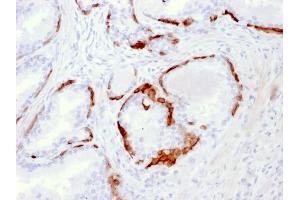 Formalin-fixed, paraffin-embedded human Prostate Carcinoma stained with Cytokeratin 14 Mouse Monoclonal Antibody (LL002). (KRT14 抗体  (C-Term))