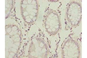 Immunohistochemistry of paraffin-embedded human colon cancer using ABIN7143865 at dilution of 1:100 (ENO1 抗体  (AA 2-428))