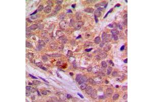 Immunohistochemical analysis of LKB1 staining in human breast cancer formalin fixed paraffin embedded tissue section. (LKB1 抗体  (C-Term))