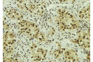 ABIN6267117 at 1/100 staining Human breast cancer tissue by IHC-P.