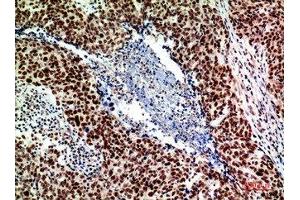 Immunohistochemical analysis of paraffin-embedded human-breast-cancer, antibody was diluted at 1:200 (ACER2 抗体  (Internal Region))