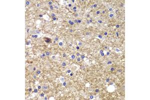 Immunohistochemistry of paraffin-embedded human brain cancer using CDK6 antibody.