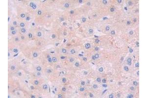 Detection of JAK2 in Human Liver cancer Tissue using Polyclonal Antibody to Janus Kinase 2 (JAK2) (JAK2 抗体  (AA 508-800))