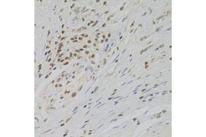 Immunohistochemistry of paraffin-embedded human gastric cancer using TAF1C Antibody. (TAF1C 抗体  (AA 70-320))