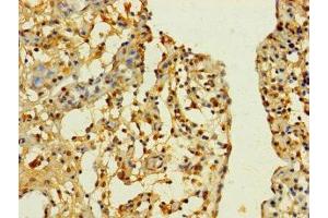 Immunohistochemistry of paraffin-embedded human bladder cancer using ABIN7170195 at dilution of 1:100 (SLC25A4 抗体  (AA 40-102))