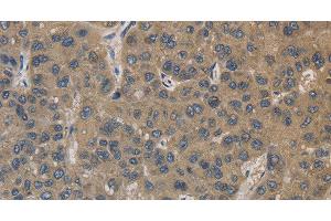 Immunohistochemistry of paraffin-embedded Human liver cancer using EMC8 Polyclonal Antibody at dilution of 1:30 (COX4NB 抗体)