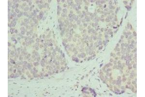 Immunohistochemistry of paraffin-embedded human gastric cancer using ABIN7142845 at dilution of 1:100 (RPL9 抗体  (AA 1-192))