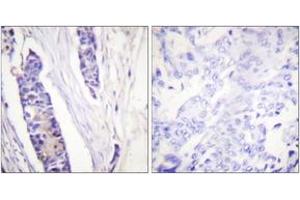 Immunohistochemistry analysis of paraffin-embedded human breast carcinoma tissue, using Tubulin beta Antibody. (TUBB 抗体  (AA 401-450))