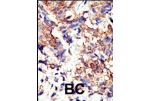 Formalin-fixed and paraffin-embedded human cancer tissue reacted with the primary antibody, which was peroxidase-conjugated to the secondary antibody, followed by DAB staining. (Ubiquilin 1 抗体  (N-Term))