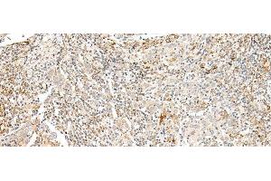 Immunohistochemistry of paraffin-embedded Human cervical cancer tissue using TAAR2 Polyclonal Antibody at dilution of 1:40(x200) (GPR58 抗体)