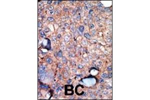 Immunohistochemistry (Paraffin-embedded Sections) (IHC (p)) image for anti-Inhibitor of kappa Light Polypeptide Gene Enhancer in B-Cells, Kinase epsilon (IKBKE) (AA 686-716), (C-Term) antibody (ABIN392751)