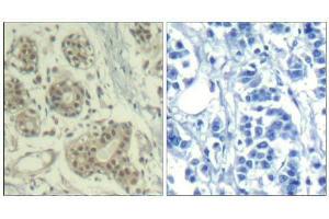 Immunohistochemical analysis of paraffin-embedded human breast carcinoma tissue using MDM2 (phospho-Ser166) Antibody (E011550). (MDM2 抗体  (pSer166))