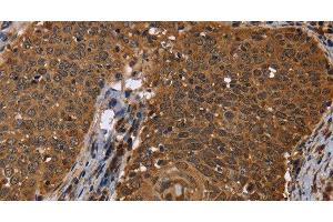 Immunohistochemistry of paraffin-embedded Human cervical cancer using DCP1A Polyclonal Antibody at dilution of 1:50 (DCP1A 抗体)