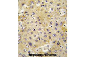 Formalin-fixed and paraffin-embedded human hepatocarcinomareacted with PPBP polyclonal antibody , which was peroxidase-conjugated to the secondary antibody, followed by AEC staining. (CXCL7 抗体  (AA 99-128))