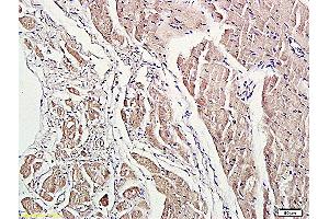Formalin-fixed and paraffin embedded human lung carcinoma labeled with Anti-phospho-ROCK1(Thr455/Ser456) Polyclonal Antibody, Unconjugated (ABIN707771) at 1:200 followed by conjugation to the secondary antibody and DAB staining. (ROCK1 抗体  (pSer456, pThr455))