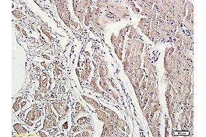 Formalin-fixed and paraffin embedded human lung carcinoma labeled with Anti-phospho-ROCK1(Thr455/Ser456) Polyclonal Antibody, Unconjugated (ABIN707771) at 1:200 followed by conjugation to the secondary antibody and DAB staining. (ROCK1 抗体  (pSer456, pThr455))