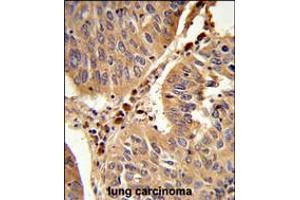 Formalin-fixed and paraffin-embedded human lung carcinoma reacted with PEX16 Antibody , which was peroxidase-conjugated to the secondary antibody, followed by DAB staining. (PEX16 抗体  (AA 247-275))