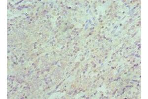 Immunohistochemistry of paraffin-embedded human colon cancer using ABIN7151313 at dilution of 1:100 (XIAP 抗体  (AA 1-200))