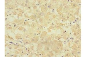 Immunohistochemistry of paraffin-embedded human gastric cancer using ABIN7151805 at dilution of 1:100 (TMPRSS15 抗体  (AA 40-300))
