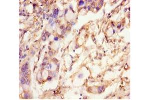 Immunohistochemistry of paraffin-embedded human pancreatic cancer using ABIN7168723 at dilution of 1:100 (SCAMP2 抗体  (AA 1-153))