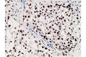 Immunohistochemistry (IHC) image for anti-Tumor Protein P53 (TP53) antibody (ABIN1499968) (p53 抗体)