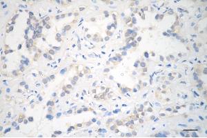 Immunohistochemistry was performed on paraffin-embedded human lung adenocarcinoma using UBE2L3 antibody (ABIN7800748), 1:200).