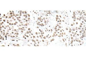 Immunohistochemistry of paraffin-embedded Human prost ate cancer tissue using SNRPA Polyclonal Antibody at dilution of 1:30(x200) (SNRPA1 抗体)